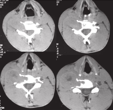 Plain Ct Scan Showing A Dumbbell Tumor On Right Side With Widening Of