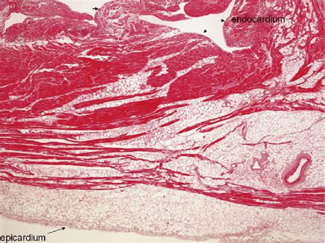 Histological View From Specimen Of Right Ventricular Free Wall Showing