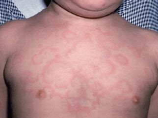 Drug Reaction Skin Rash And Medication Causing Skin E Vrogue Co