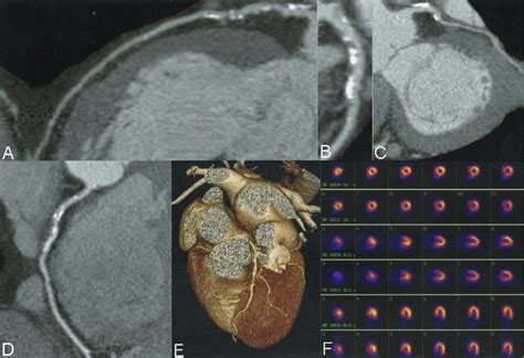 Relationship Between Noninvasive Coronary Angiography With Multi Slice