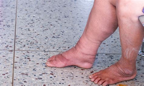 Lymphedema Living With Swelling And Stiffness Nih Medlineplus