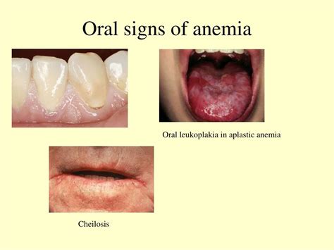 Ppt Anaemia Powerpoint Presentation Free Download Id3317514