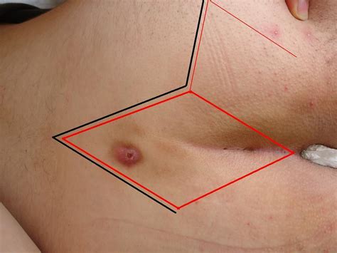 Pilonidal Sinüs Ameliyat Resimleri Pilonidal Sinüs