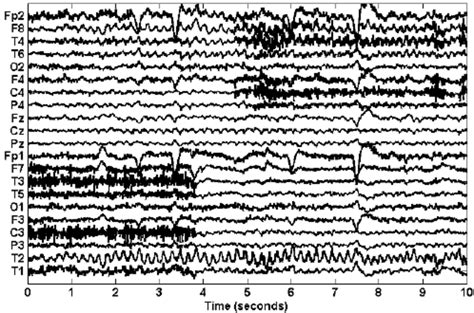 The Ictal 10 Second Scalp Eeg Recordings Contaminated With Eye Blinks Download Scientific