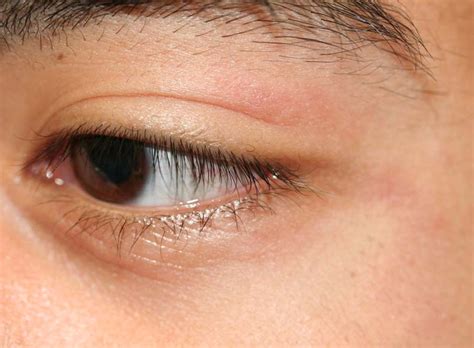 You may be familiar with the fact that eczema is a condition that can cause dry, itchy skin, a rash, and other symptoms, but you also probably wouldn't think it could bloom on your freaking eyelids. Eyelid Dermatitis (xeroderma of the eyelids, eczema of the ...