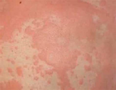 Healthool Hiv Rash Pictures What Does Hiv Rash Look Like How Is