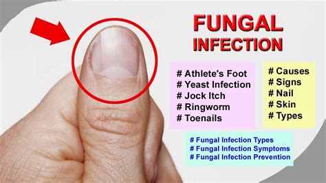 Types Of Skin Fungus Infections Leroy Cohen Headline