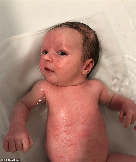 Newborns Acne Cleared Up Thanks To A £799 Coconut Oil Best Health Tale
