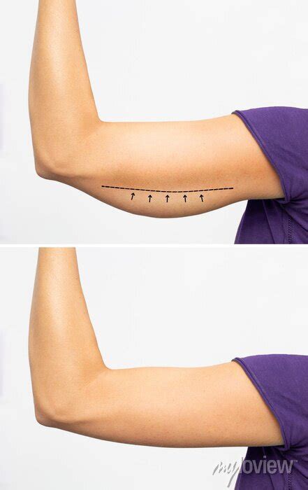 Saggy Skin Removal And Arm Before And After Toning Exercises Wall