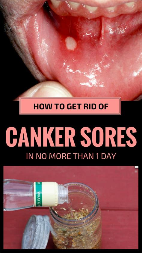 How Do I Know If A Canker Sore Is Healing Get Free Information