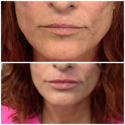 Laser Lip Lines Treatment Laser And Fillers For Lip Wrinkle And Smokers Lines