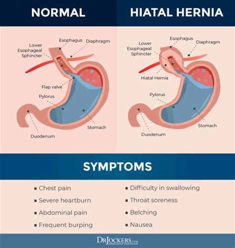 Hiatal Hernia Symptoms Causes And Natural Support Strategies In 2021