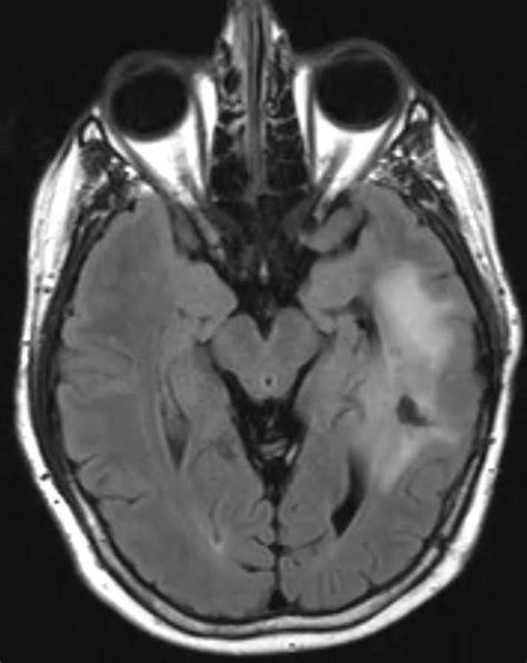 Astrocytoma Temporal Lobe Neuro Mr Case Studies Ctisus Ct Scanning