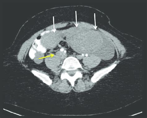 Axial Image Of A Contrast Enhanced Abdomen And Pelvis Ct Scan At The