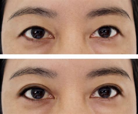 Double Eyelid Plastic Surgeon Qualities You Should Consider Grace Chua