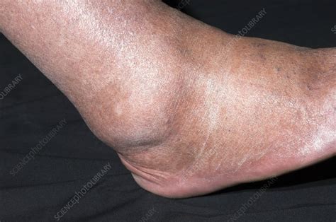 Osteoarthritis Of The Ankle