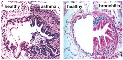 Materials | Free Full-Text | On the Role of Mechanics in Chronic Lung