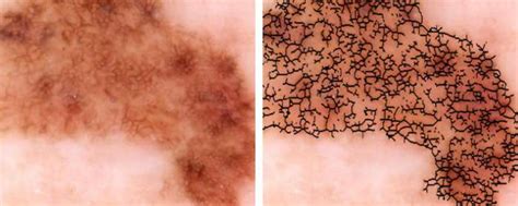It may be black, abnormal, or ugly looking. Desarrollan detector automático de melanomas | Cluster ...