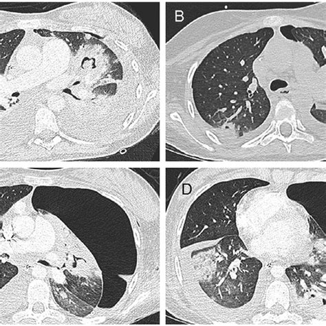 Baseline Contrast Enhanced Chest Computed Tomography Ct Baseline