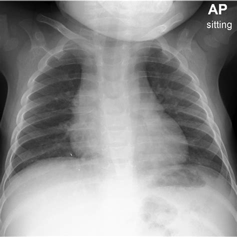 Follow Up Chest X Ray 11 Months After The Initial Presentation Showing