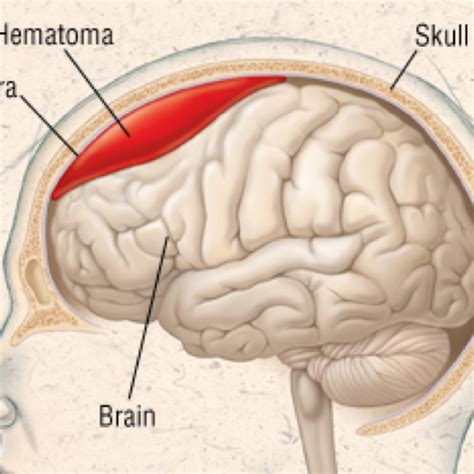 Signs Of Subdural Hematoma