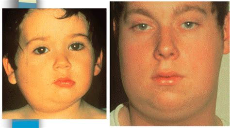 S2b1 Infectious Diseases Mumps And Acute Bacterial Parotitis