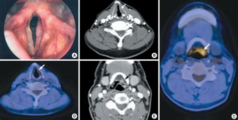 A 62 Year Old Man With Glottic Squamous Cell Carcinomas Open I