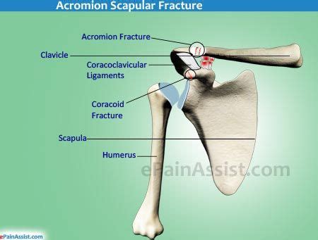 What Is A Acromion Fracture Google Search Shoulder Joint Scapula