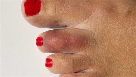 Broken Toe Treatments Symptoms Pictures And Healing Time