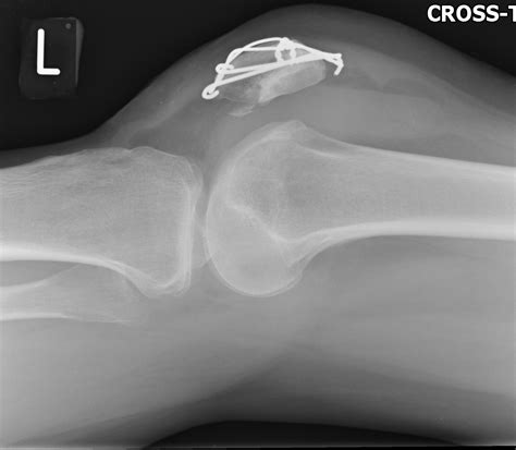 Patellar Fracture Fixation An Unreported Complication Occurring