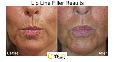 Lip And Smoker Lines Improvement With Natural Looking Results Charmed