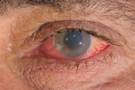 Ocular Bee Sting Injury A Rare Cause Of Endophthalmitis Ophthalmology