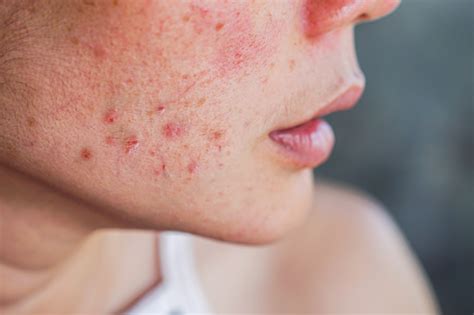 Common Bacterial Skin Infections Causes Symptoms Diagnosis