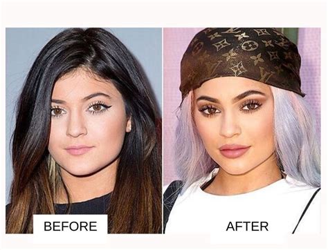 Kylie Jenner Plastic Surgery Before And After Images 2022 Fabbon