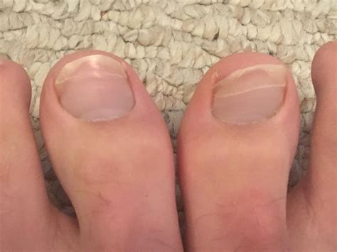 Not A Medical Professional Does Anyone Know Why My Big Toe Toenails
