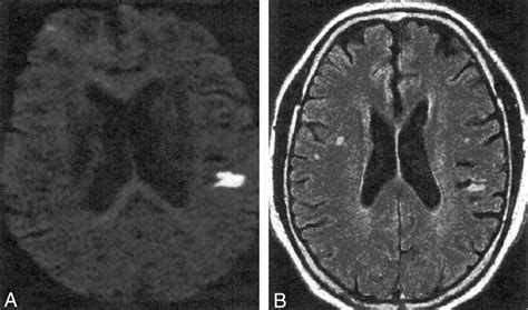 Diffusion Weighted Mr Imaging In The Acute Phase Of Transient Ischemic