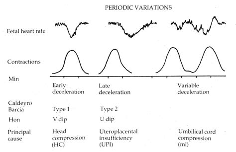 Diagrammatic Representation Of Early Late And Variable Decelerations