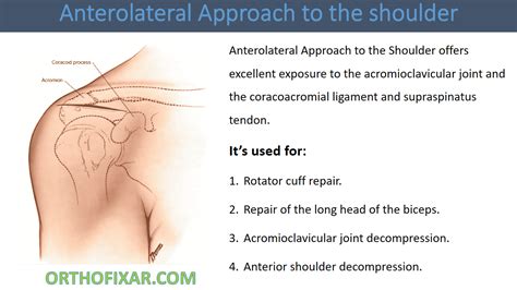 Anterolateral Approach To The Shoulder
