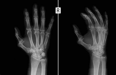 Esqueleto Mano Derecha Radiografía De La Mano Muestra La Subluxación