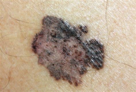 Why Does Melanoma Sometimes Turn A Mole Purple Scary Symptoms