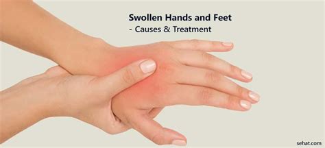 Swollen Hands And Feet Causes And Treatment