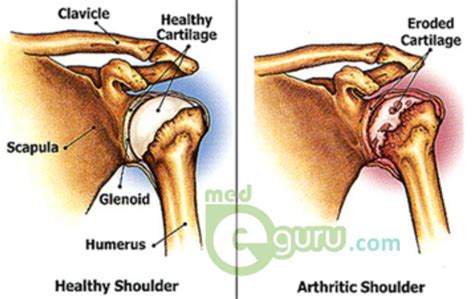 Shoulder Arthritis Causes Symptoms Rheumatoid Arthritismed E Guru