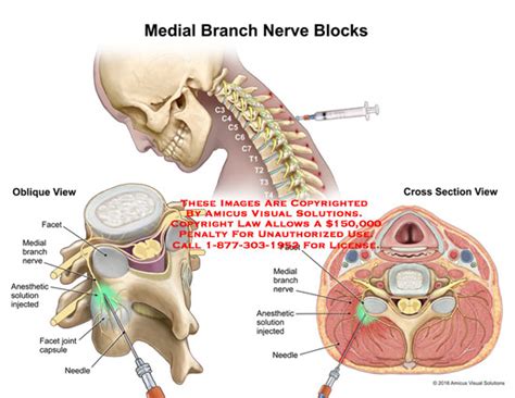 AMICUS Illustration Of Amicus Medical Injections Neck Nerve Block