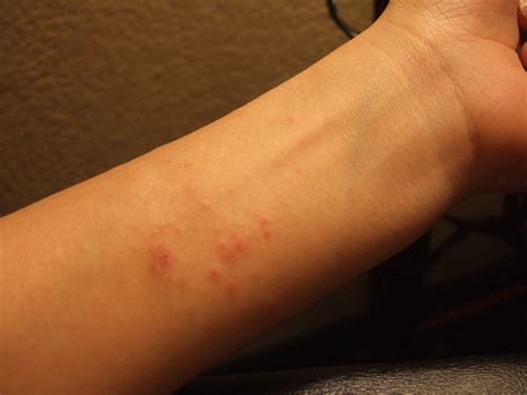 Attack Back Mold Allergies Zachwires Blog