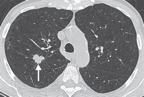 Solitary And Multiple Pulmonary Nodules Radiology Key