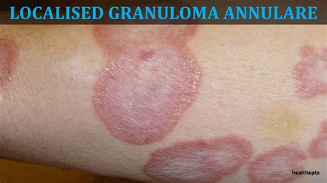 Granuloma Annulare Pictures Granuloma Annulare Dermnet Nz These
