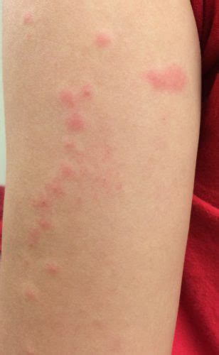 Woman With Rash Journal Of Urgent Care Medicine
