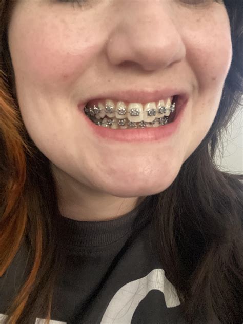 32 Years Old And Just Got Braces For The First Time I Really Cant