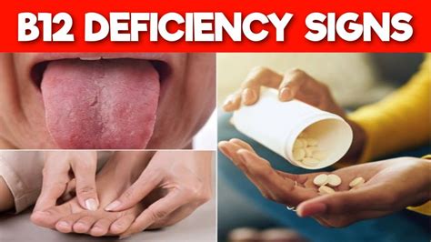 B DEFICIENCY SYMPTOMS Signs And Symptoms Of Vitamin B Deficiency