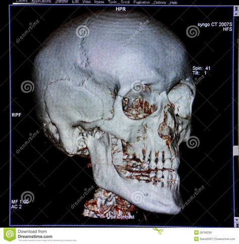 Skull, CT-scan Reconstruction, Anatomy Stock Photo - Image of